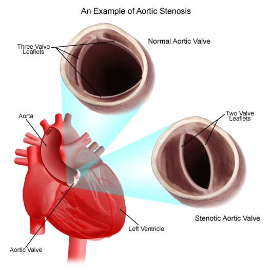 ضيق الصمام الأورطي Aortic-stenosis