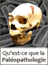 Musée Préhistoire de Nemours Paleopathologie