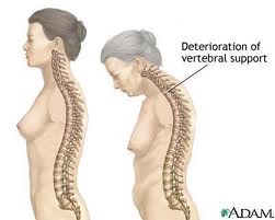 Οστεοπόρωση Osteoporosis2