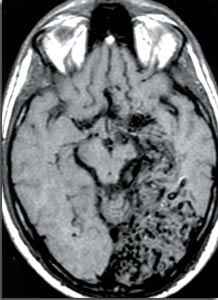 Quand prescrire une imagerie à un migraineux ? Carac_photo_1