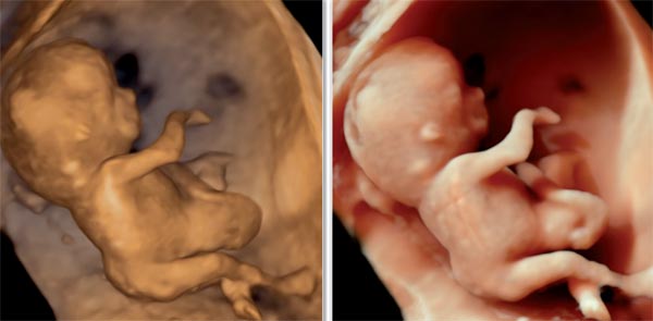 Le HD Live, révolution dans la visualisation 3D du foetus Media_figure7