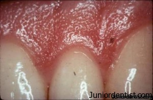 Gingiva  اللثة موضوع كامل Stiplled-gingiva-300x196