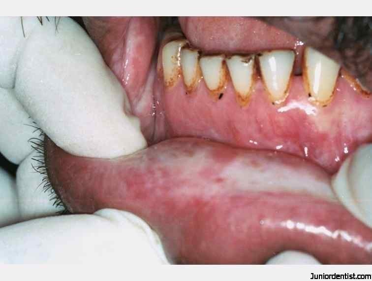 Oral Submucous Fibrosis  OSF-Blanching-of-lower-lip