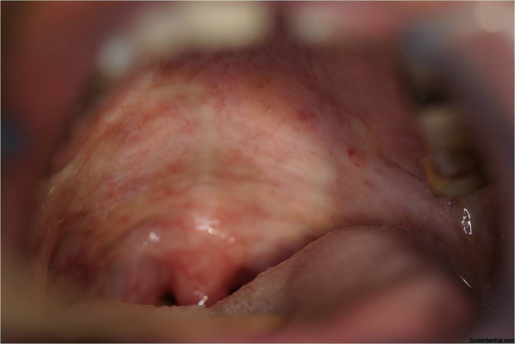 Oral Submucous Fibrosis  OSF-Soft-palate-1024x683