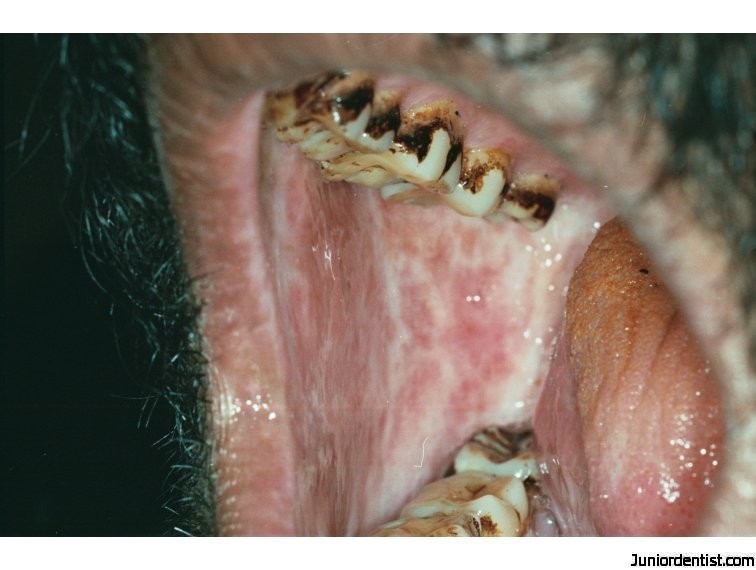 Oral Submucous Fibrosis  OSF-buccal-mucosa