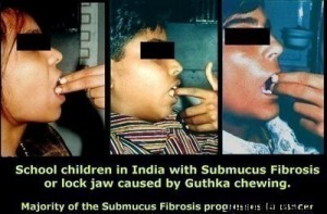 Oral Submucous Fibrosis  School_children_India_submucus_fibrosis-300x197