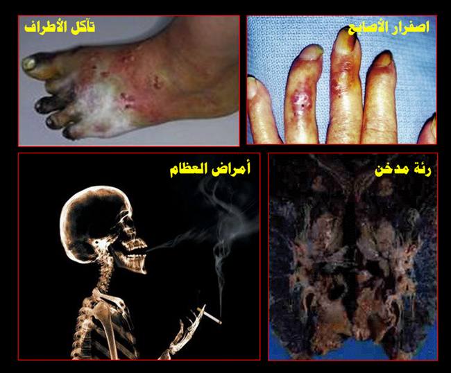 صور مرعبة: التدخين يقتل شخصاً كل 6 ثوان Smoking-harmful-04