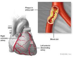 Bllokimi i arterieve Arterijet