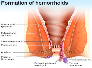 Ja ilaçi për hemorroidet Hemorrhoidet-300x221