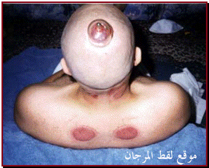 صوره توضيحية عن الحجامة Cupping11