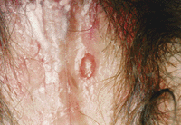 Herpes #1 e #2 ❖ Vulvodinia.info Herpes_genitale_femminile