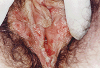 Herpes #1 e #2 ❖ Vulvodinia.info Herpes_primario