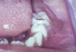 LES CELLULITES D'ORIGINE DENTAIRE CHEZ L'ENFANT Fig1b