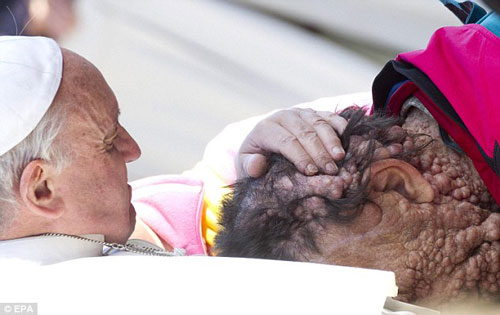 بابا الفاتيكان يسحر القلوب بتقبيله رأس رجل مصاب بمرض جلدي خطير Pope_028930899176392801_