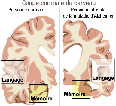 Tri' nho+' giam sut, phai lam sao ? Alzheimer