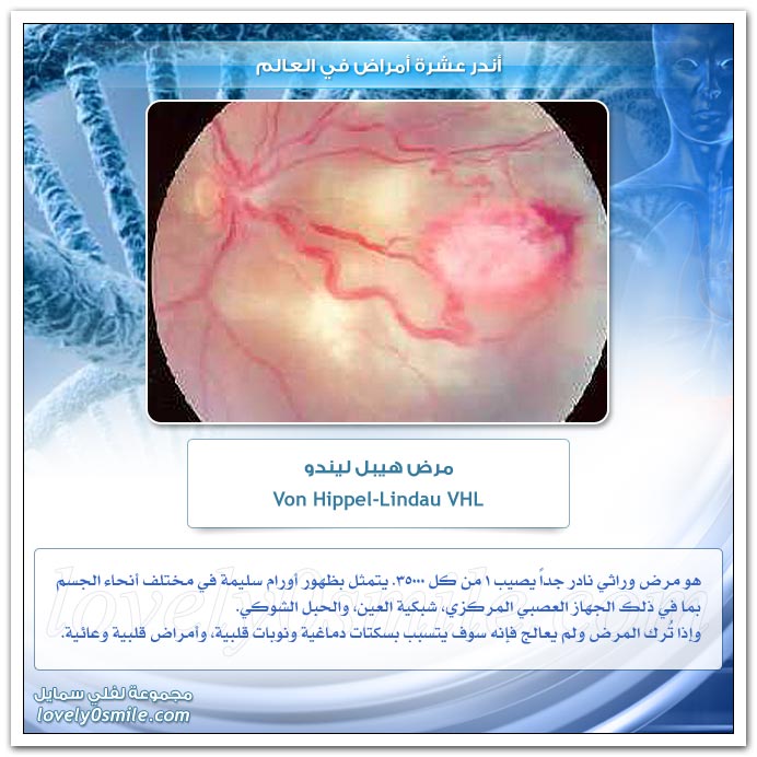 أخطر عشرة أمراض في العالم TopRarestDiseases-07