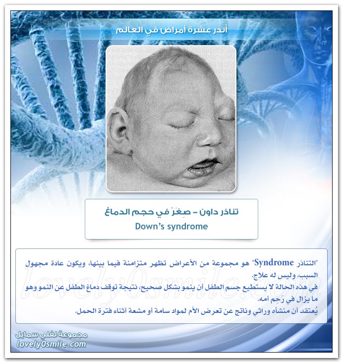 أخطر عشرة أمراض في العالم TopRarestDiseases-08