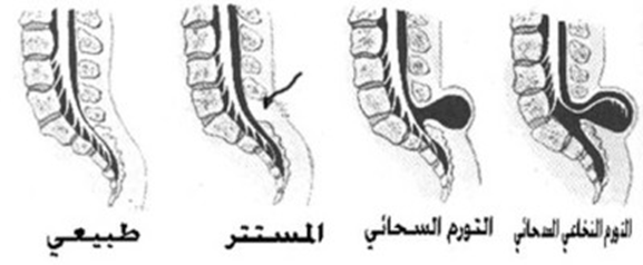 الصلب المشقوق 013111060149uqofwsjwb81kt9462