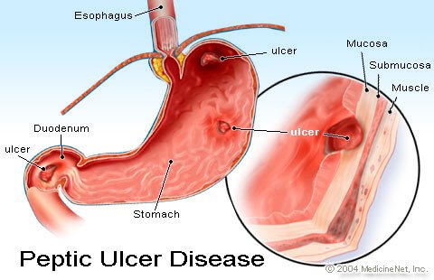 القرحة المعدة وطرق الوقاية والعلاج عا فانا الله Peptic_ulcer