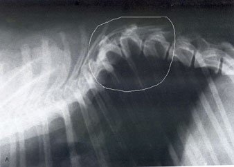 HEMIVERTEBRA Radiologia-hemivertebra