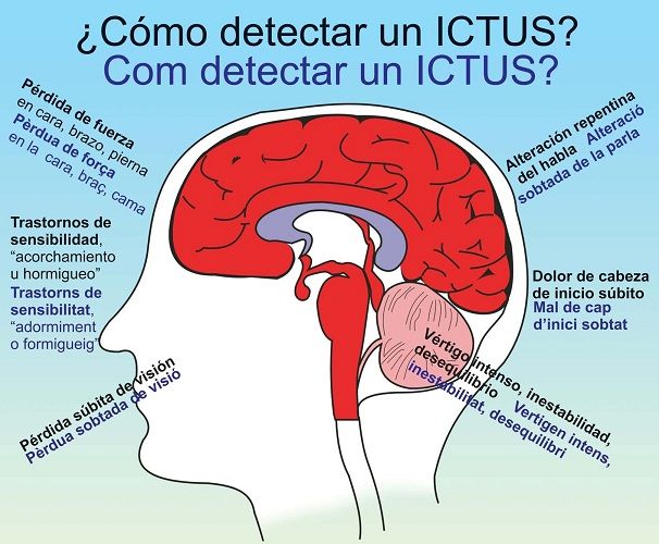 Recuperarse de un ictus tocando música Ictus