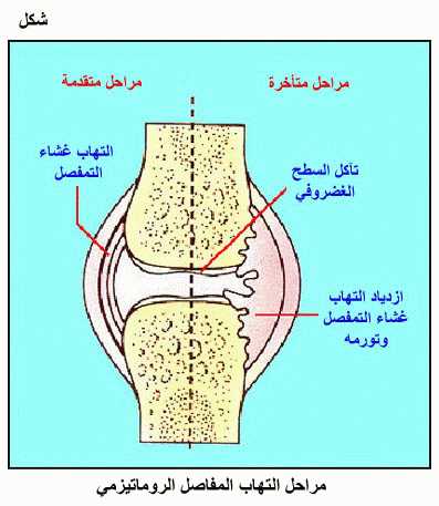 إلتهاب المفاصل    Fig06.gif_cvt01