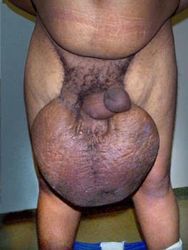 awesome Elephantiasis5