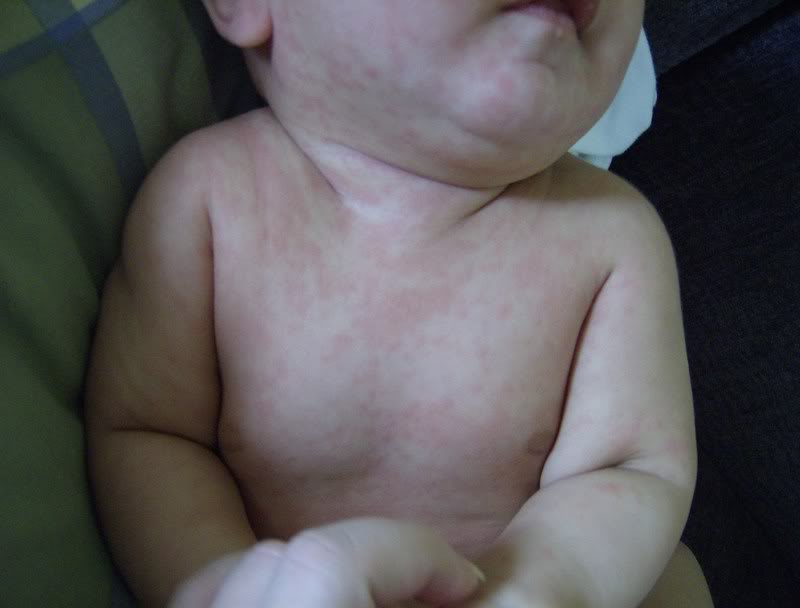 الطفح الوردي (الحمى الورديه )  Roseola