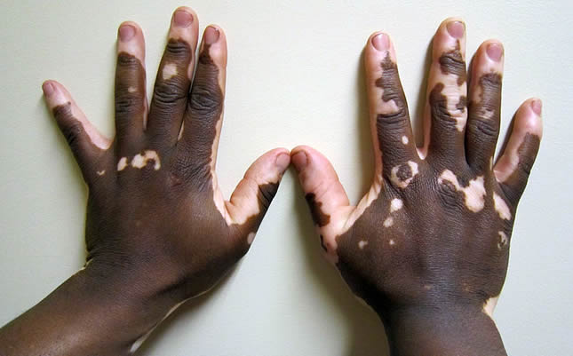 ALTERNATIVNA MEDICINA Vitiligo2