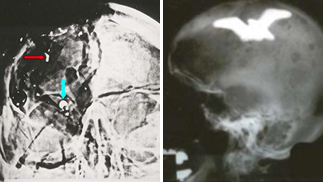  autopsy EXCLUSIVE: JFK autopsy 'bullet fragment' X-ray was faked, denounced as 'physically impossible' ... New forensic analysis uncovers decades of false evidence used to frame Lee Harvey Oswald JFK-Skull-X-Ray