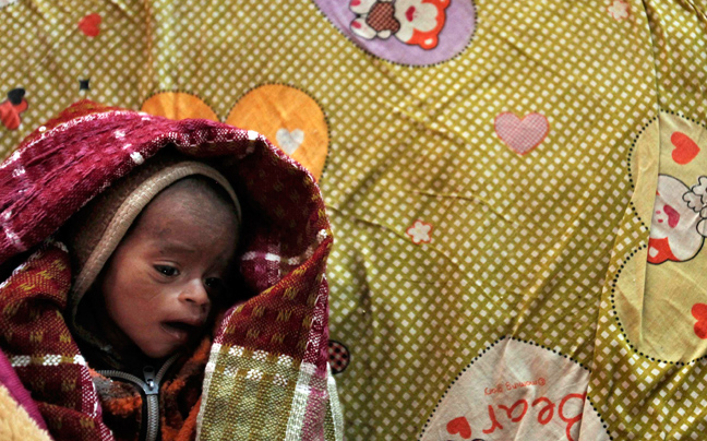 Παιδιά ενός κατώτερου θεού INDIA_MALNUTRITION8