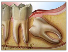 ضرس العقل * Wisdom Teeth  32