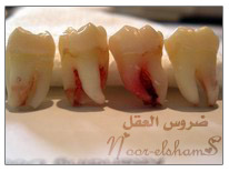 ضرس العقل * Wisdom Teeth  34