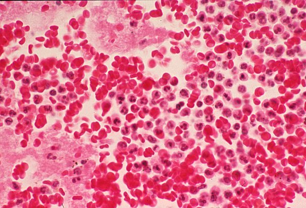 Neutrophil Và Xuất Huyết 035