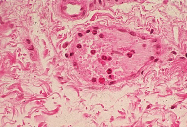 Lymphocyte Trong Mô 049