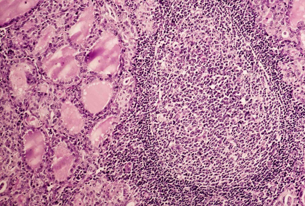 spot diagnosis - صفحة 5 Hashimotos-follicle-thyroid-glands-2-1024x691