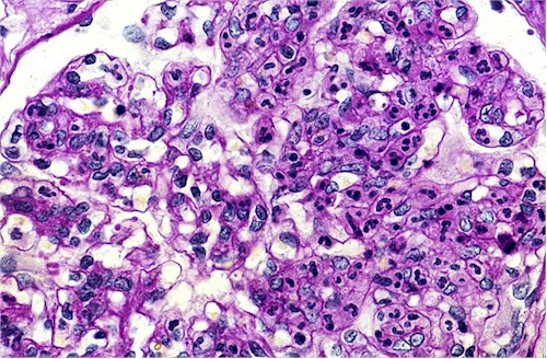 QUIZ VIRTUAL: APARATO YUXTAGLOMERULAR Y GLOMERULONEFRITIS POR MARIA MONICA TORRES 102102055 Glomerulonefritis_aguda_histopatologia