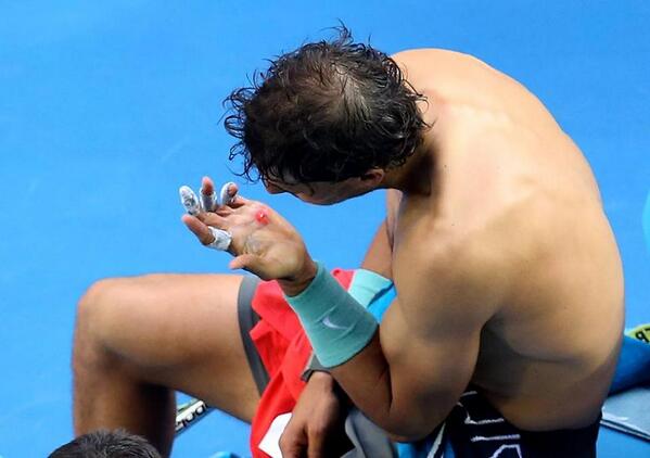 La calva de Manu Carreño Nadalhand