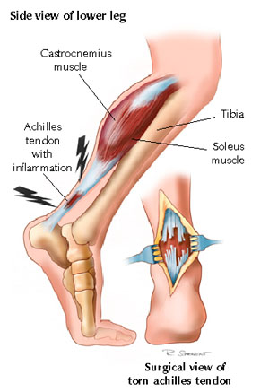 مرض ألبرت Achilles_tendon_rupture