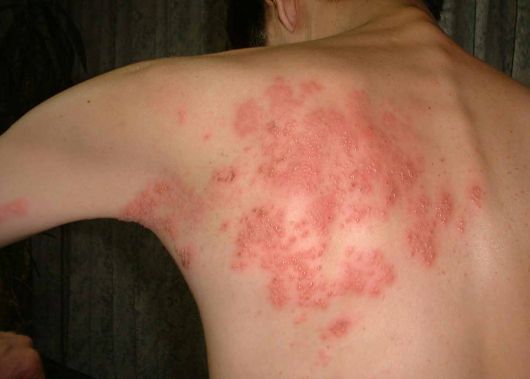spot diagnosis Herpes-zoster-shingles2