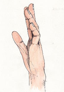 Why is my pinky finger bent? (camptodactyly) Camptodactyly