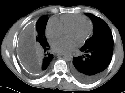 Aspect tomodensitométrique des séquelles et des compliquation de la tuberculose Nassar2009_15