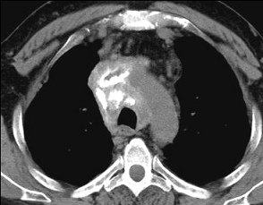 Aspect tomodensitométrique des séquelles et des compliquation de la tuberculose Nassar2009_17