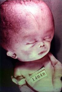 Rh negative facts and fiction – truth and contradictions Hydrocephalus-baby-202x300