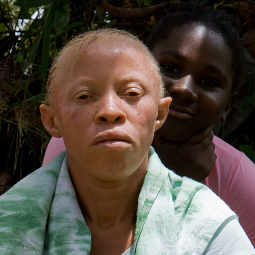 Esiste l’albinismo tra le persone di colore? Albino-di-colore