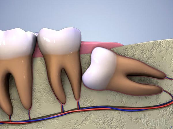 Pourquoi vous avez besoin de vos dents de sagesse Dents-de-sagesse