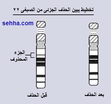 متلازمة دي جورج  DiGeorge Syndrom DiGeorge_Syndrome05