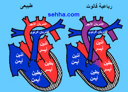 متلازمة دي جورج  DiGeorge Syndrom DiGeorge_Syndrome07