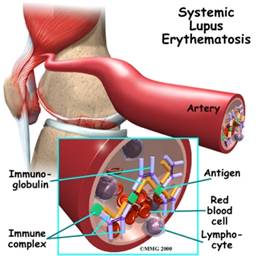 الذئبة الحمراء الجهازية Systemic Lupus Erythematosus SLE01
