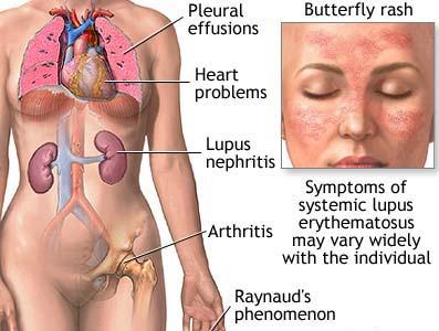    Systemic Lupus Erythematosus SLE02